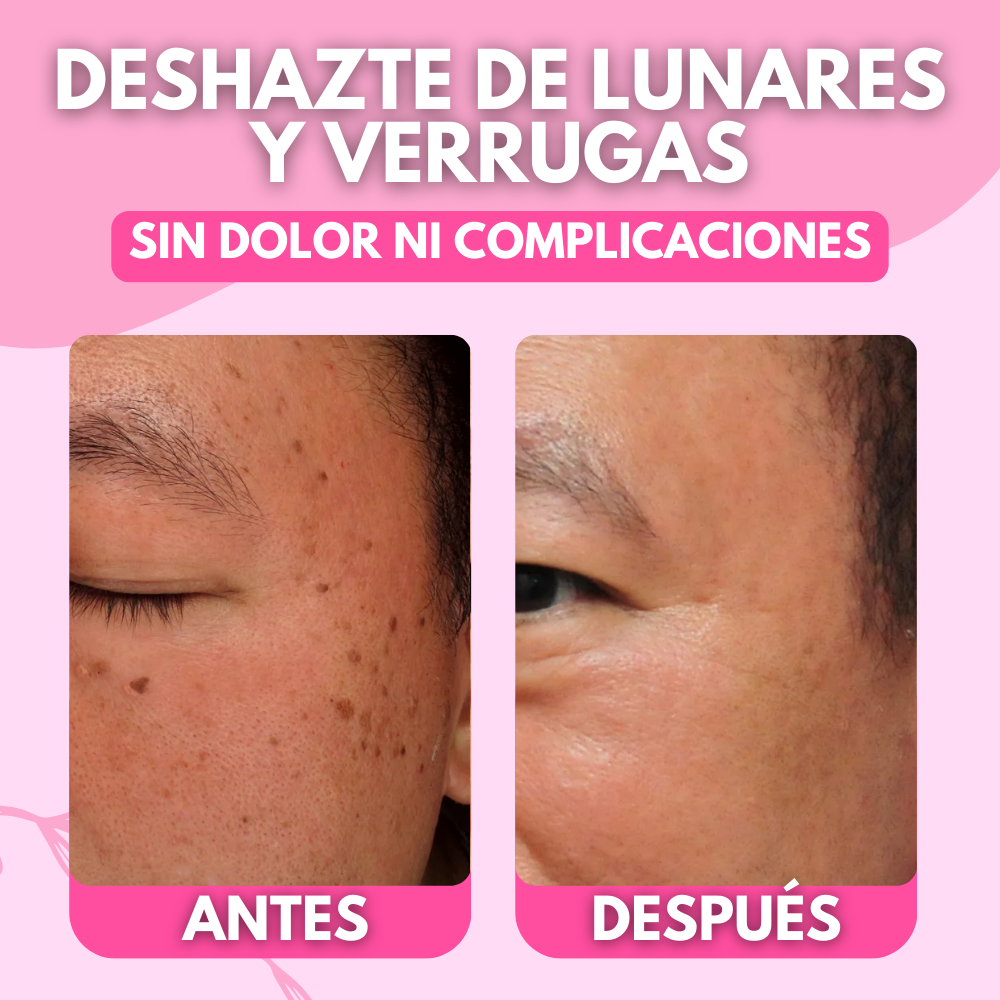 CLEAR SKIN PRO™ NUEVA FORMULA REMOVEDORA DE LUNARES, PECAS Y VERRUGAS